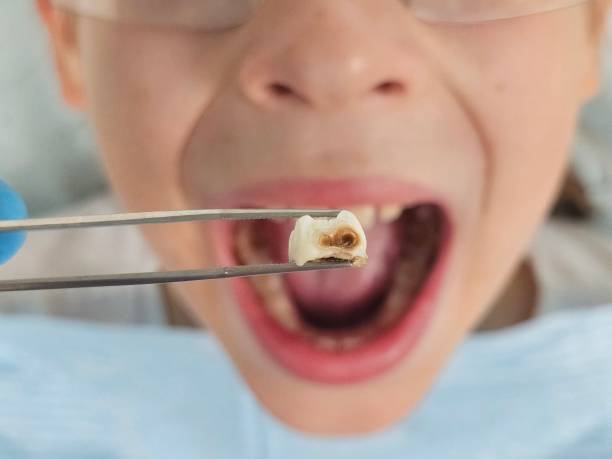 Best Tooth Infection Emergency Dentist  in Granville, OH